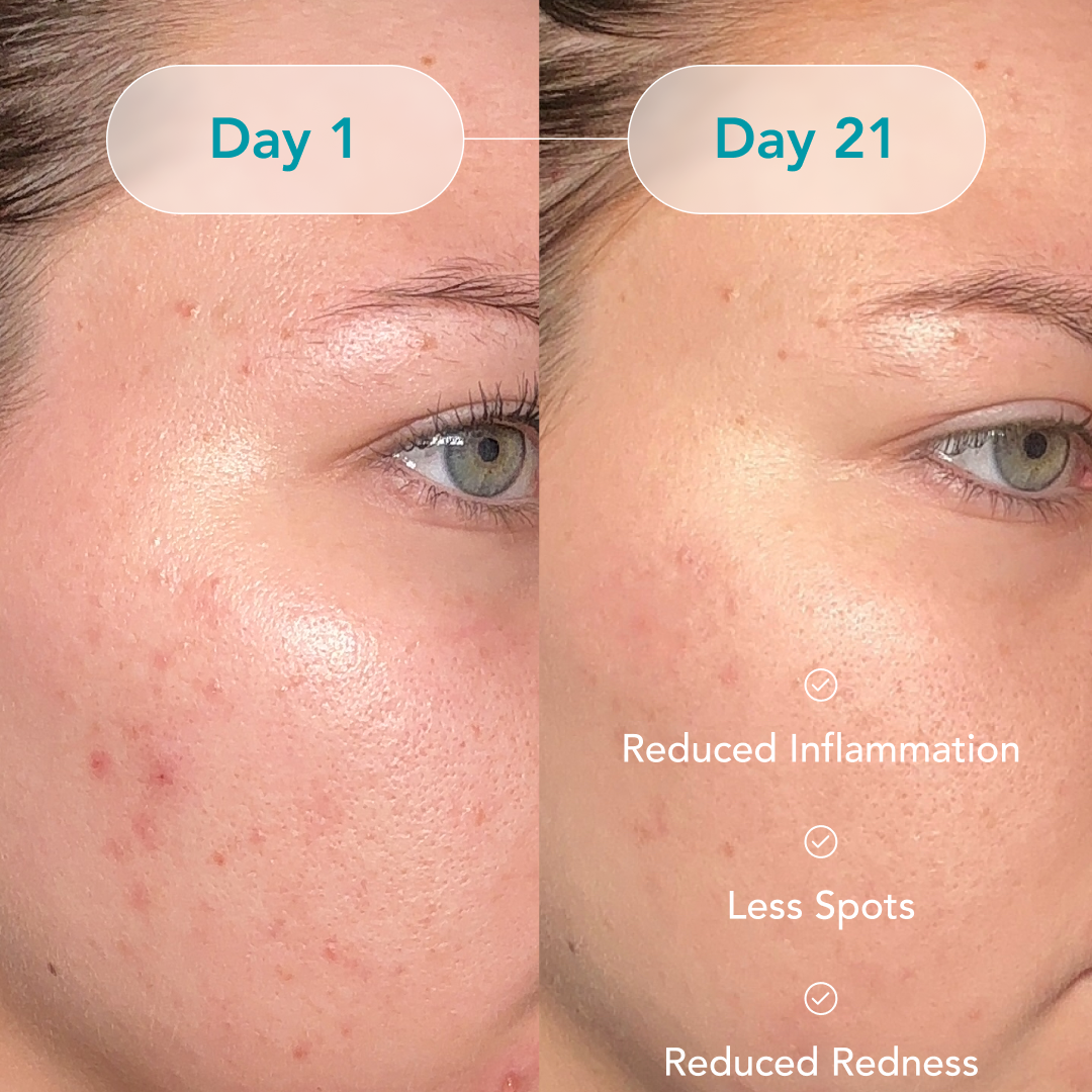 Riversol Comprehensive Acne Treatment